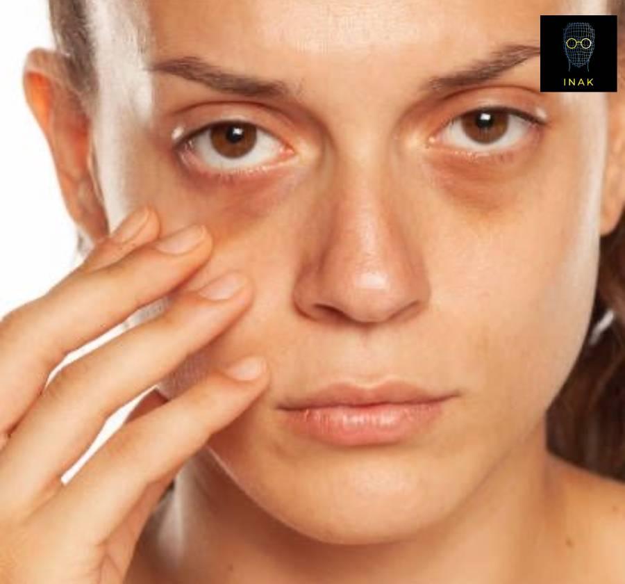 آیا عینک طبی باعث گودی و سیاهی دور چشم می شود؟ بررسی علمی یک باور رایج